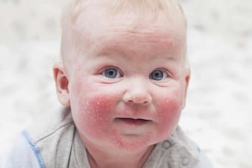 baby-eczema