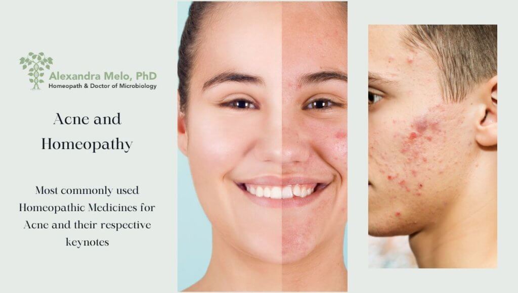 Acne and Homeopathy
